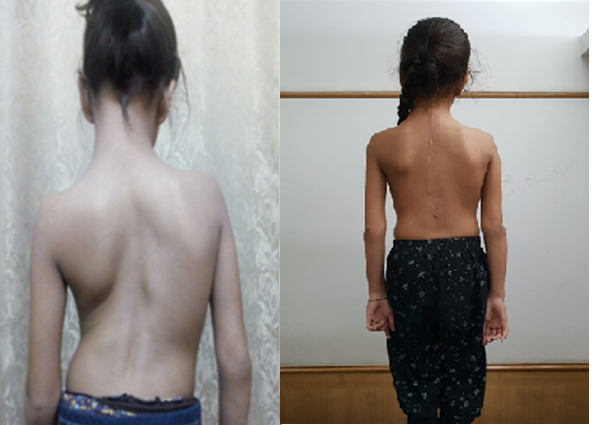Spinal Deformity Correction By Dr. Ajay Kothari