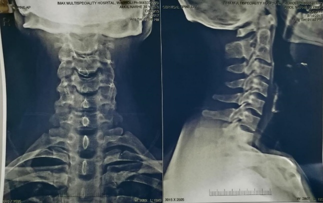 Preop x-ray