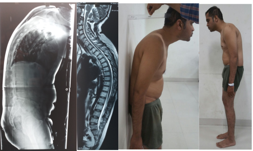 Ankylosing Spondylitis Treatment Pre-Op